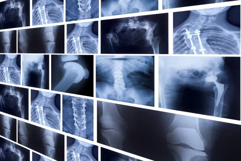 X-ray
